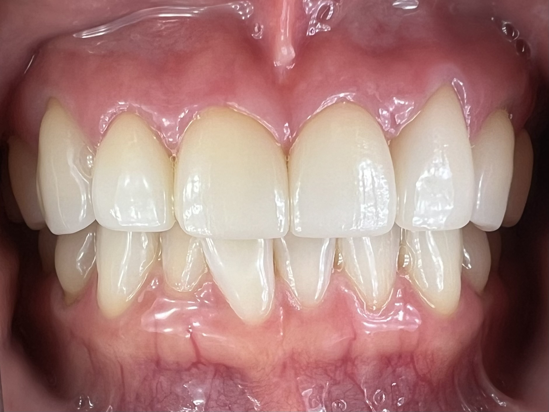 After treatment
