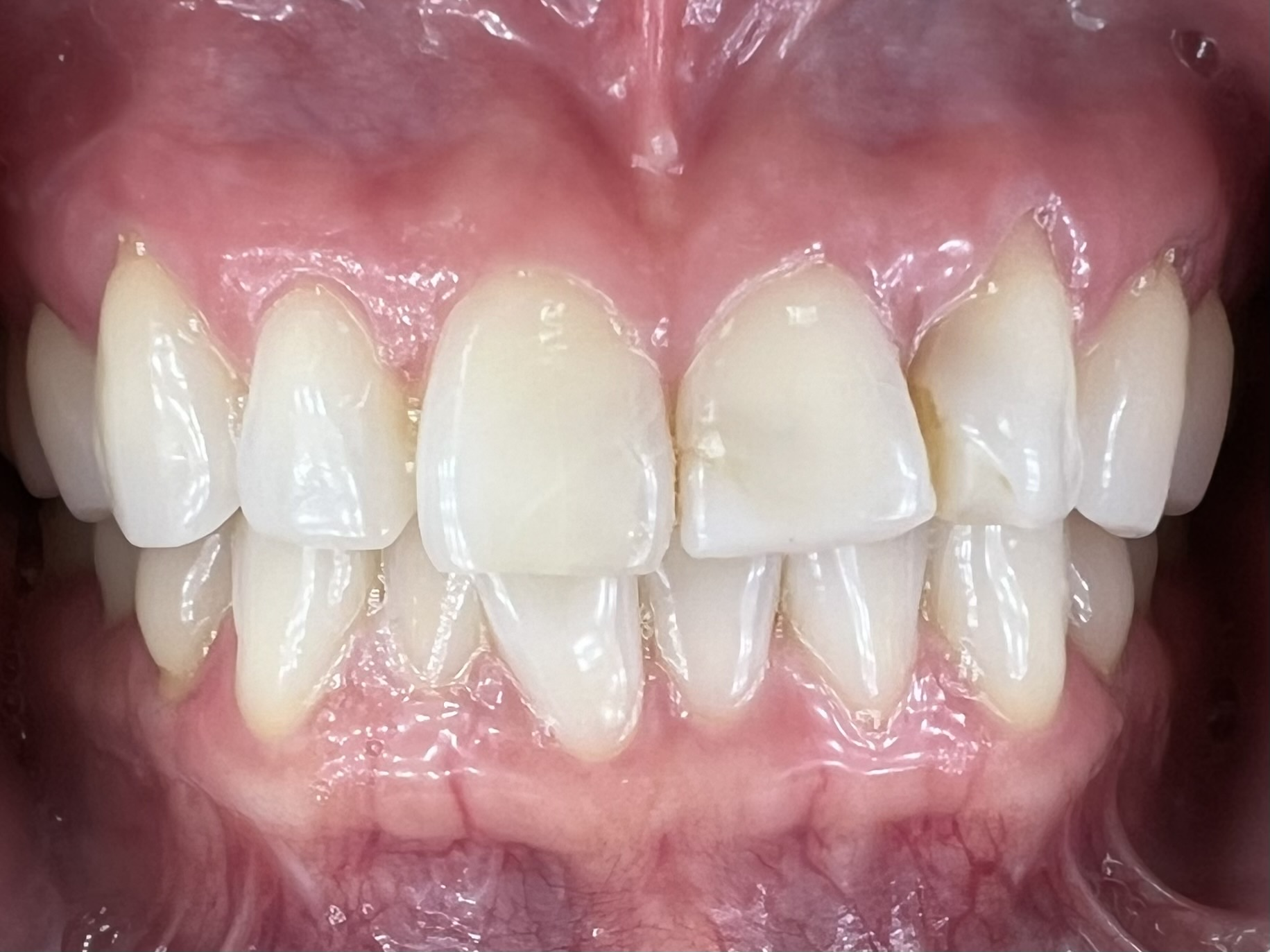 Before treatment